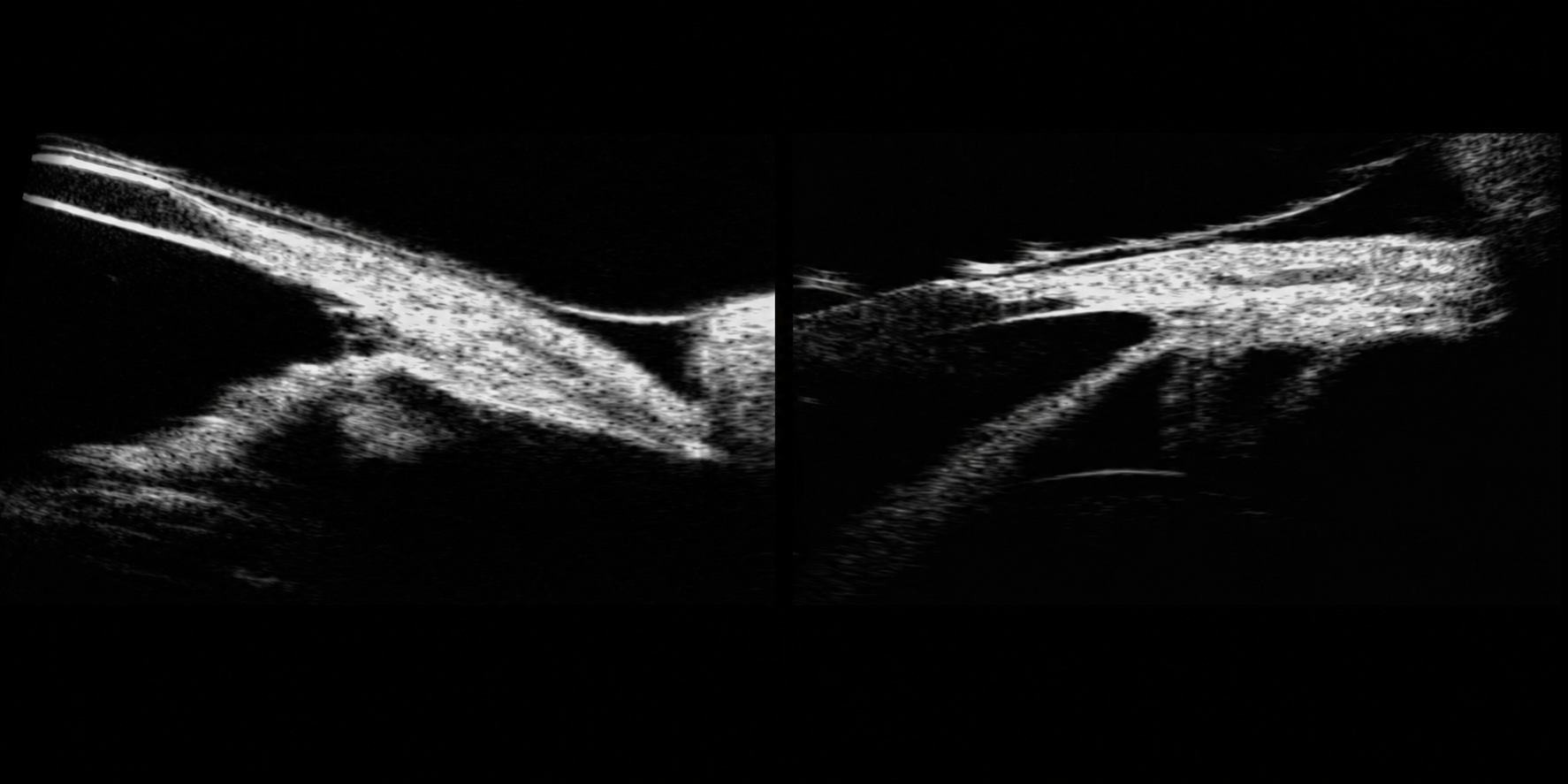 Imagem de biomicroscopia ultrassônica ocular